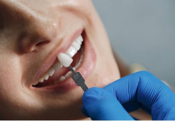 Dental Implants