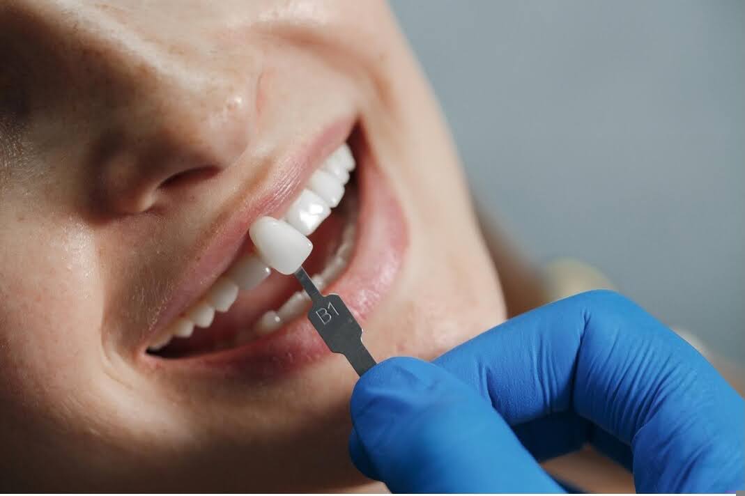 Dental Implants